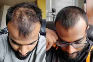 Before and after hair restoration comparison.