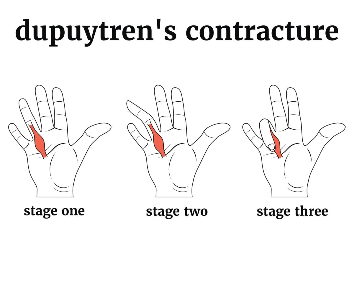 Diagram of Dupuytren's contracture stages on hands.