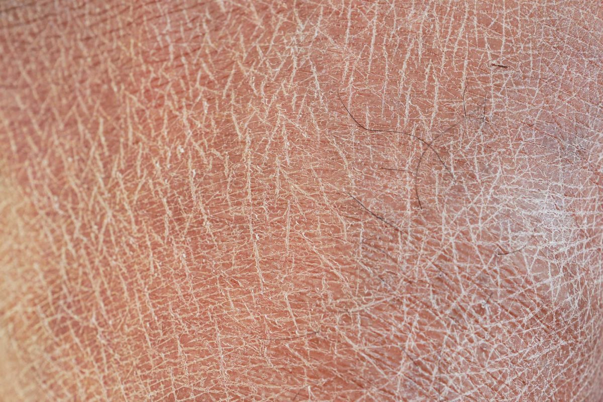 Close-up of severely dry, flaky human skin